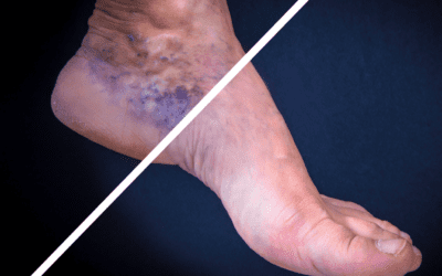 Understanding Venous Insufficiency and Varicose Veins